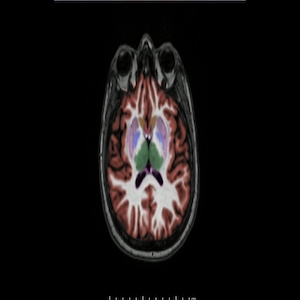 صورة من نوع من فحوص المسح الدماغي المعتمدة على التصوير بالرنين المغناطيسي (جرى تلوينها اصطناعيًا) تظهر دماغ شخص مصاب بمرض ألزهايمر.